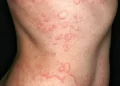 Urticaria crónica espontánea: lo que debe saber