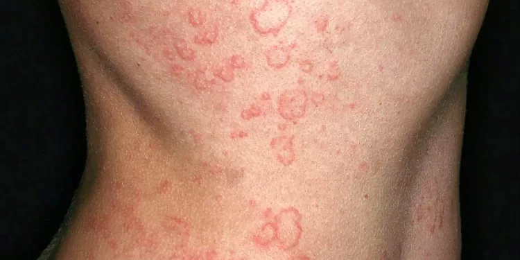 Urticaria crónica espontánea: lo que debe saber