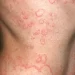Urticaria crónica espontánea: lo que debe saber
