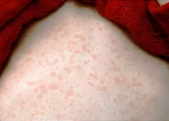 ¿Podrían los casos de sarampión en Estados Unidos batir un récord este año?  Qué saber