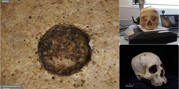 Los antiguos egipcios intentaron tratar quirúrgicamente el cáncer, según un estudio