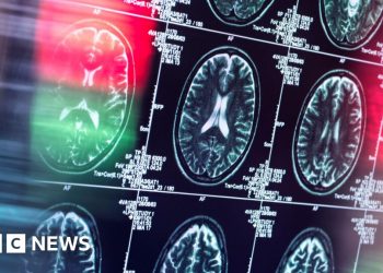 El regulador de la UE rechaza el fármaco lecanemab contra el Alzheimer