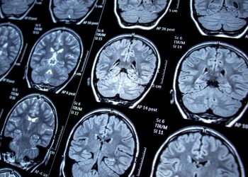 Un nuevo estudio relaciona el herpes zóster con el deterioro cognitivo