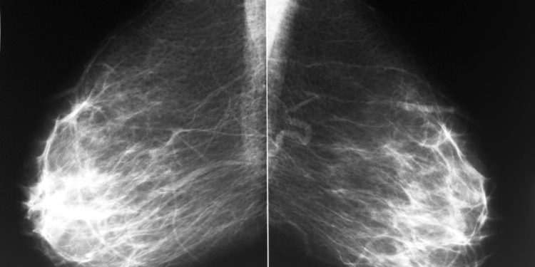 Lo que debes saber sobre los senos densos