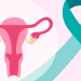 Guía integral de las opciones de tratamiento del cáncer de cuello uterino
