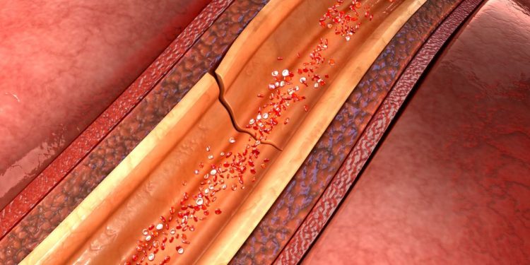 Disección de la arteria coronaria espontánea 101