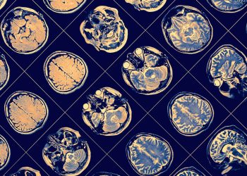 Los científicos anuncian el posible avance al retrasar el Alzheimer