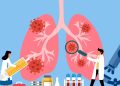 ¿Por qué la investigación de la investigación contra el cáncer pulmonar no tiene leficiente financiamiento?