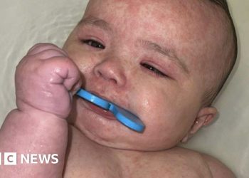 Cómo Canadá se convirtió en el centro de un brote de sarampión en América del Norte