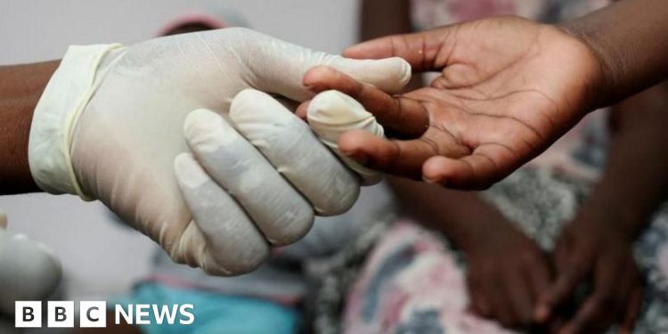 Los expertos sudafricanos se preocupan cuando los Estados Unidos se reducen al tratamiento del VIH comienzan a morder