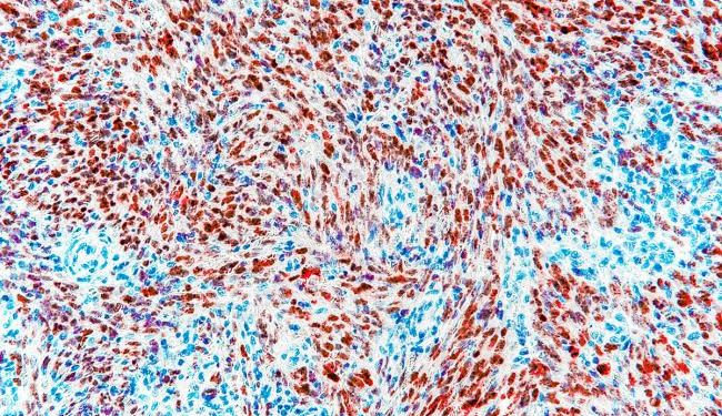 Financiación de la investigación del cáncer infantil respaldada por el HHS Duplica AI