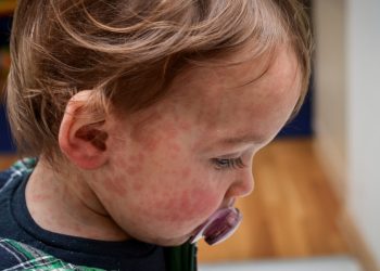 Child Dies de complicación de sarampión horrible en Los Ángeles