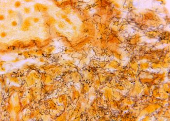 Por qué los casos de sífilis en los recién nacidos están aumentando