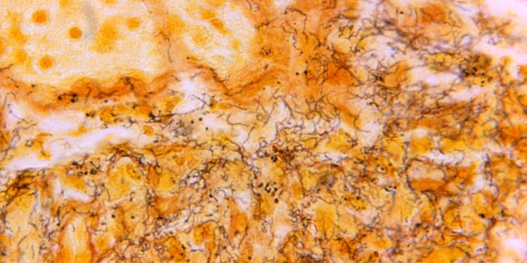 Por qué los casos de sífilis en los recién nacidos están aumentando