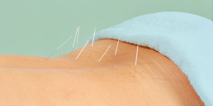 La acupuntura para el dolor de espalda puede funcionar mejor que las drogas o la fisioterapia