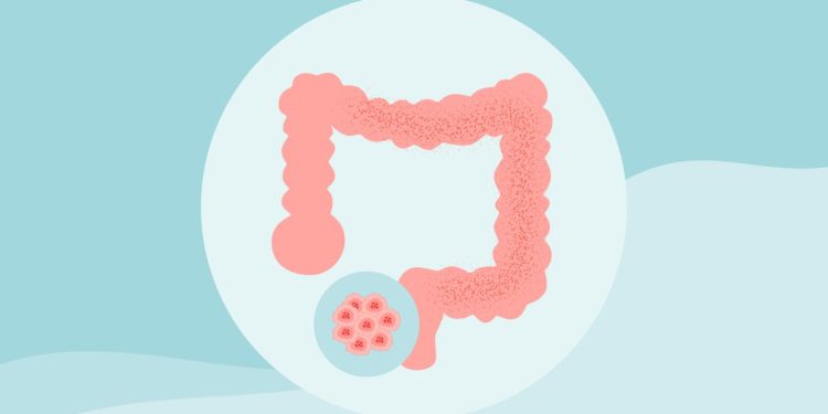 Consejos de prevención y detección temprana