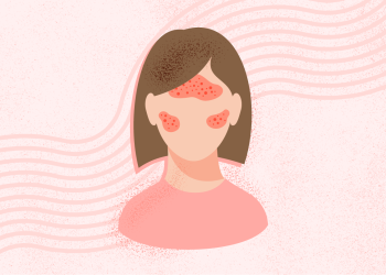 ¿Qué es la rosácea? Síntomas, causas, diagnóstico, tratamiento y prevención