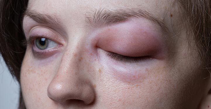 Síntomas de angioedema hereditario