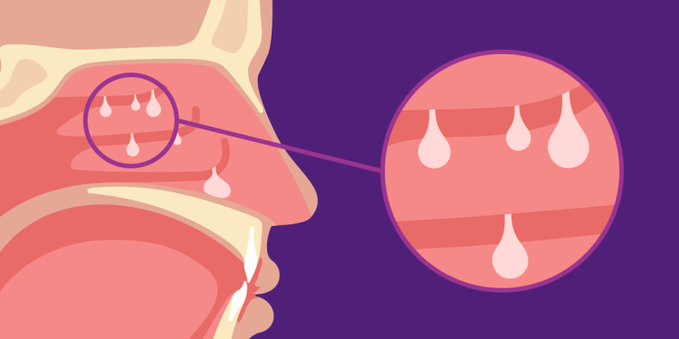 Pólipos nasales e inflamación tipo 2