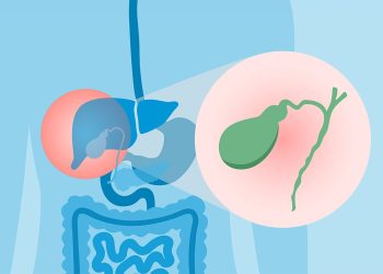 Colangitis esclerosa primaria y colitis ulcerosa: qué saber