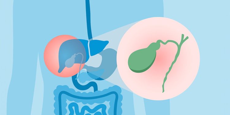 Colangitis esclerosa primaria y colitis ulcerosa: qué saber