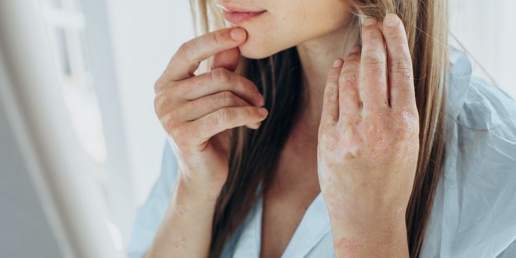 Psoriasis y trastorno bipolar: comprender su conexión