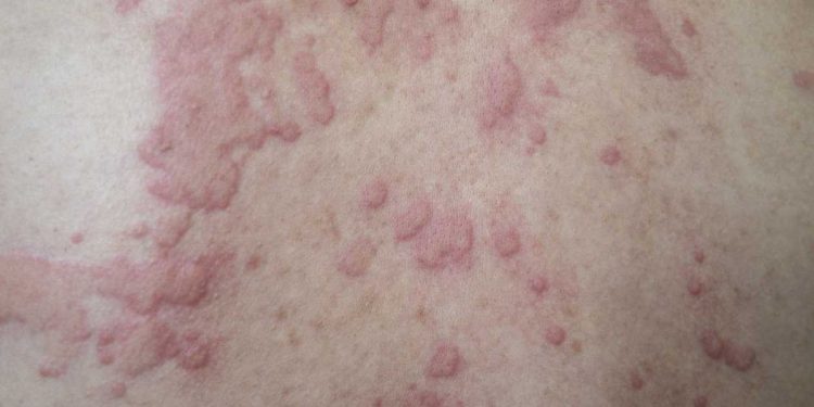 Urticaria espontánea crónica 101 – Homenomen Healthy