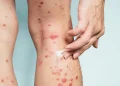 Psoriasis manchando y cicatrices: cómo hacer frente