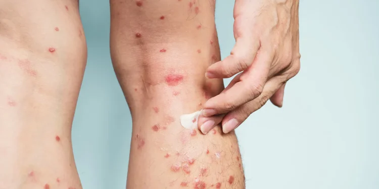 Psoriasis manchando y cicatrices: cómo hacer frente