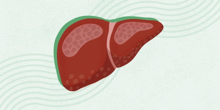 ¿Qué es la esteatohepatitis (puré) asociada a la disfunción metabólica?