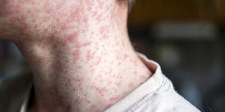 Brote de sarampión en Carolina del Sur envía a 150 niños no vacunados a cuarentena de 21 días