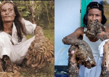 La perturbadora enfermedad del hombre árbol que transformó la vida de dos personas