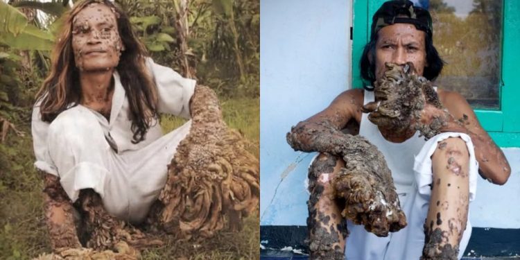 La perturbadora enfermedad del hombre árbol que transformó la vida de dos personas