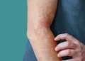 ¿Qué es la urticaria crónica espontánea (urticaria)? Síntomas, Causas, Diagnóstico, Tratamiento y Prevención