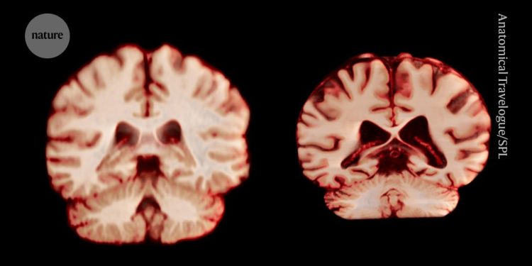 ¿Qué significa eso para el Alzheimer?