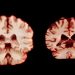 ¿Qué significa eso para el Alzheimer?