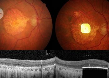 Las personas ciegas pueden volver a leer tras un implante de retina
