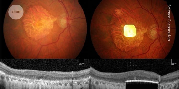 Las personas ciegas pueden volver a leer tras un implante de retina