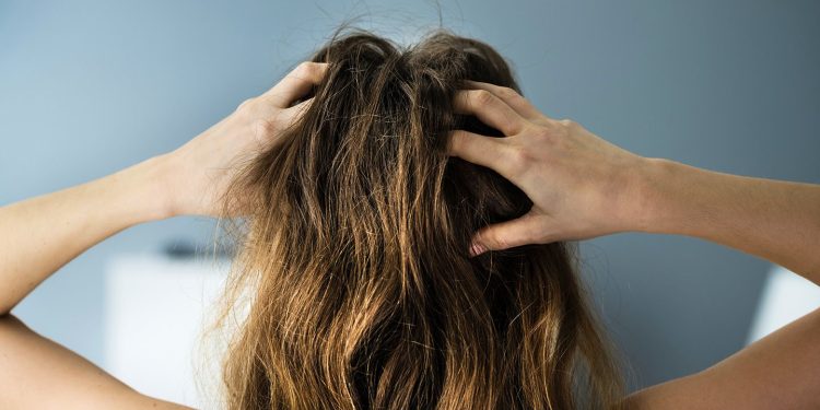 Los mejores remedios caseros para la picazón e irritación de la psoriasis del cuero cabelludo