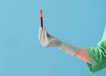 La nueva prueba puede ayudar a predecir si el cáncer de mama en etapa 0 se volverá invasivo