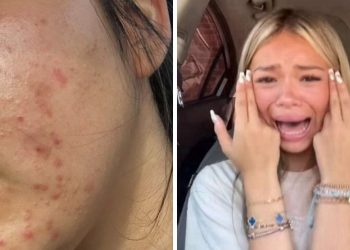 El verdadero culpable de los granitos que te salen sin razón