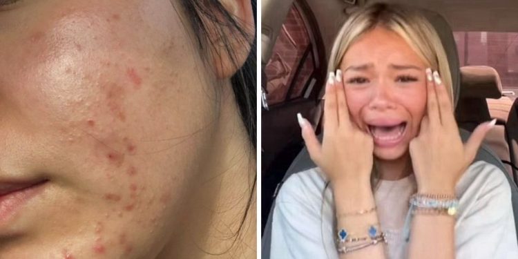 El verdadero culpable de los granitos que te salen sin razón