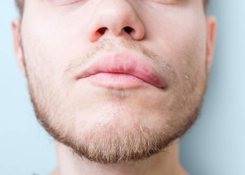 Angioedema hereditario versus alérgico: síntomas, causas y tratamientos