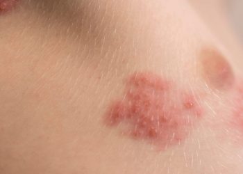 Las vacunas contra la culebrilla no sólo previenen el dolor: podrían salvarle la vida