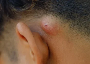 Síntomas de la infección por estafilococos