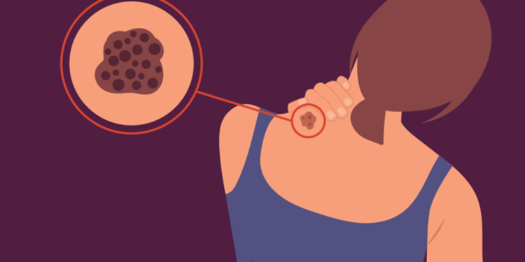 Tipos de melanoma – Mujeres Saludables