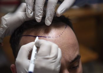 Lo que hace que este país sea el destino superior para los trasplantes de cabello: NPR