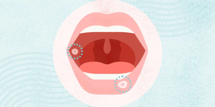 ¿Qué son las lesiones bucales?
