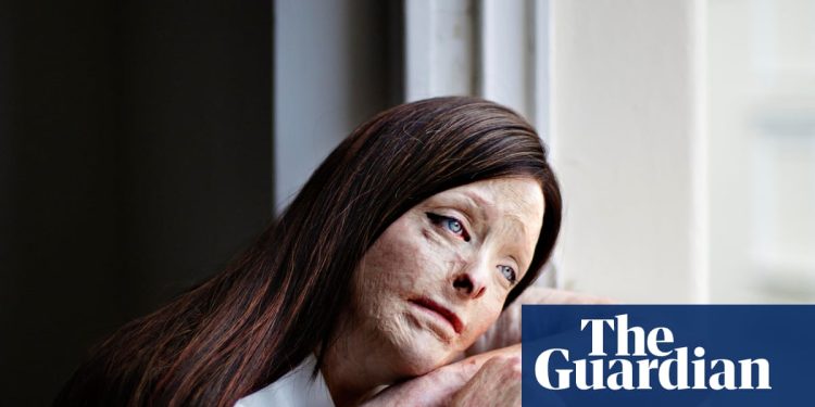 Imagen de un sobreviviente de quemaduras gana el premio de retrato fotográfico Taylor Wessing | Premio de retrato fotográfico Taylor Wessing