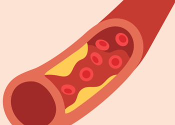 Aterosclerosis y enfermedades cardíacas – HealthyWomen